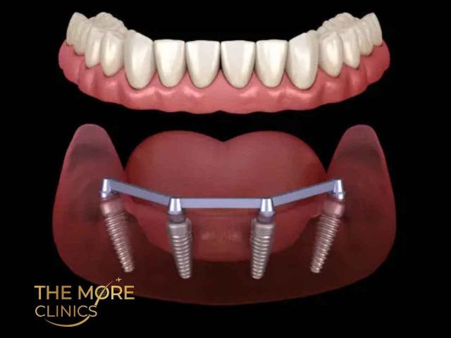 TURKEY TEETH IMPLANTS